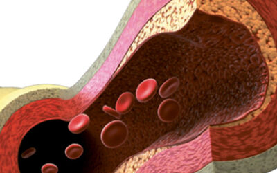 Vitamin K2 supplementation and arterial stiffness among renal transplant recipients—a single-arm, single-center clinical trial